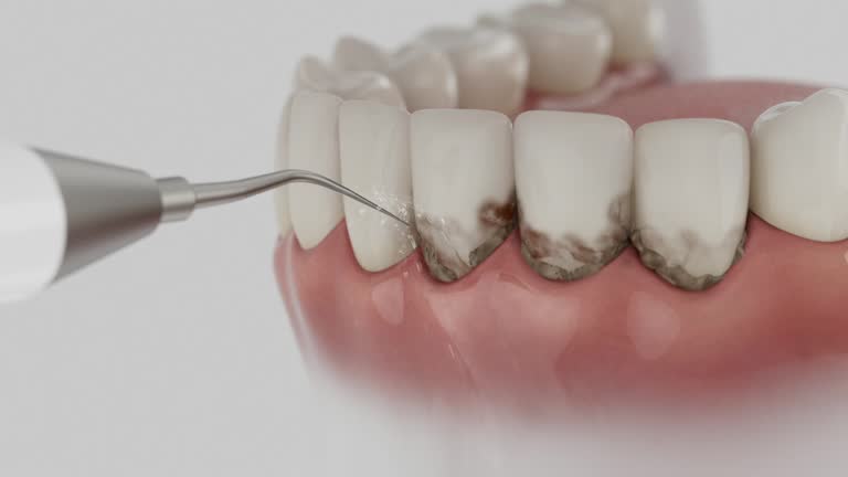 Trusted Dental Crowns And Bridges service in Gladewater, TX - Dentist Open Now